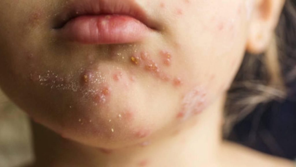 ABD’de Kızamık Salgını: Son Durum ve Önlemler