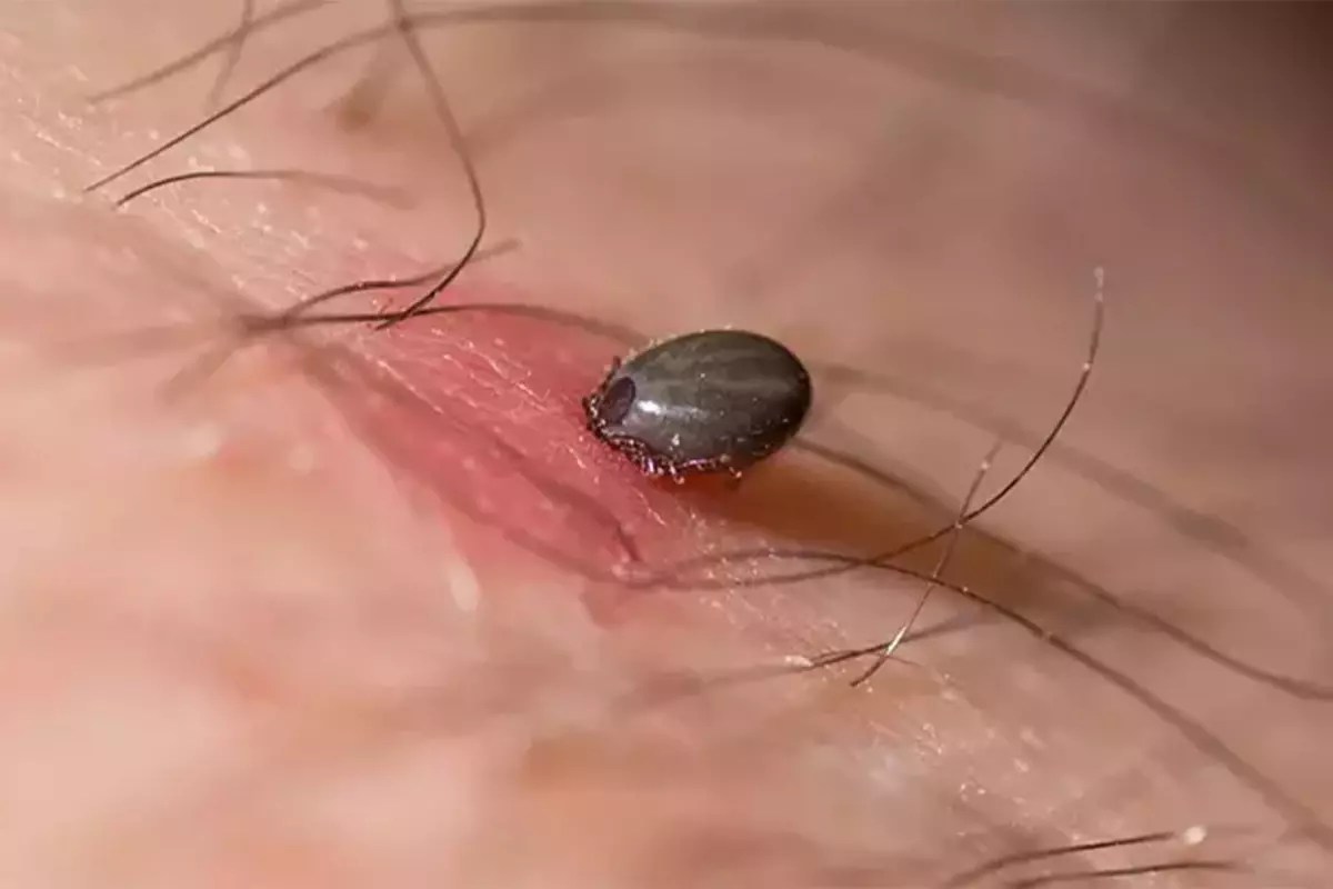 Gümüşhane’de Kene Isırması Sonucu Bir Kişi Hayatını Kaybetti