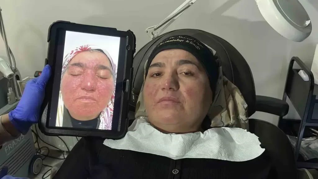 Gül Hastalığına Yeniden Hayat Kavuşan Neriman Hanımın Hikayesi